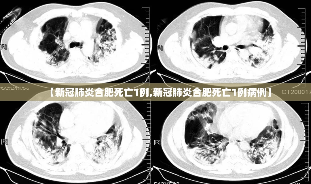 【新冠肺炎合肥死亡1例,新冠肺炎合肥死亡1例病例】